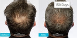 Theradome EVO Laser Hair Growth Helmet, FDA-Cleared Hair Restoration Device