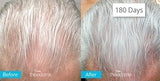 Theradome EVO Laser Hair Growth Helmet, FDA-Cleared Hair Restoration Device