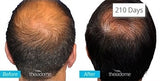 Theradome EVO Laser Hair Growth Helmet, FDA-Cleared Hair Restoration Device