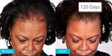 Theradome EVO Laser Hair Growth Helmet, FDA-Cleared Hair Restoration Device