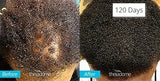 Theradome EVO Laser Hair Growth Helmet, FDA-Cleared Hair Restoration Device
